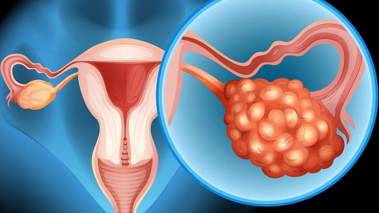 Kadın Doğum Kanserleri